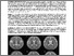 [thumbnail of Breuer_Fatal Astrovirus Encephalitis in a paediatric stem cell transplant recipient.pdf]