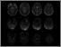 [thumbnail of Lunn_covid encephalitis Figure.pdf]